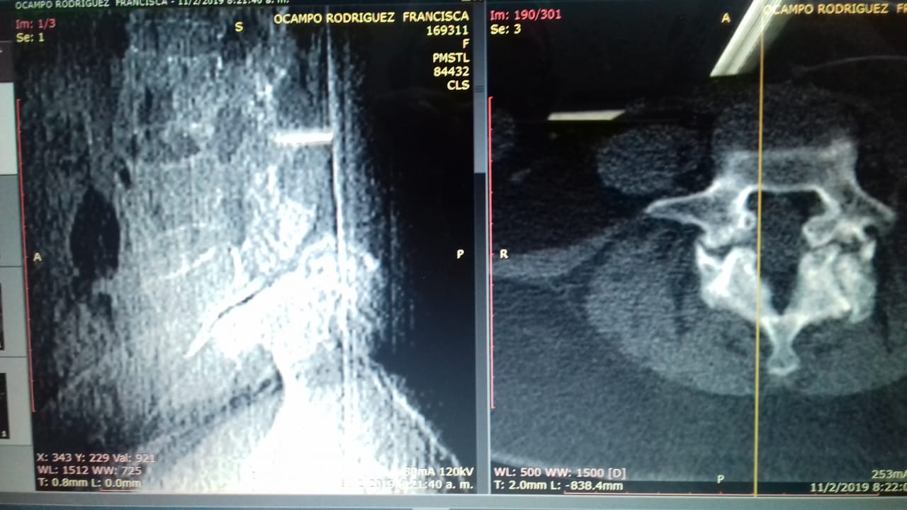 Fem. 60 años. Listesis L5S1 Dolos lumbar. Incapacidad Adormecimiento Pos quirúrgico sin evento. Sin Daño neurológico Seguimiento