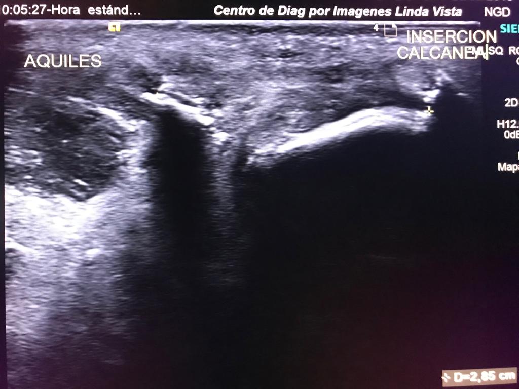 Ultrasonido de Tobillo. Femenina 55 años