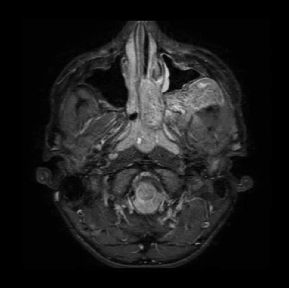 Angiofibroma Juvenil