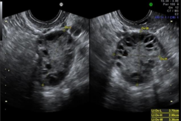 SINDROME DE OVARIOS POLIQUÍSTICOS