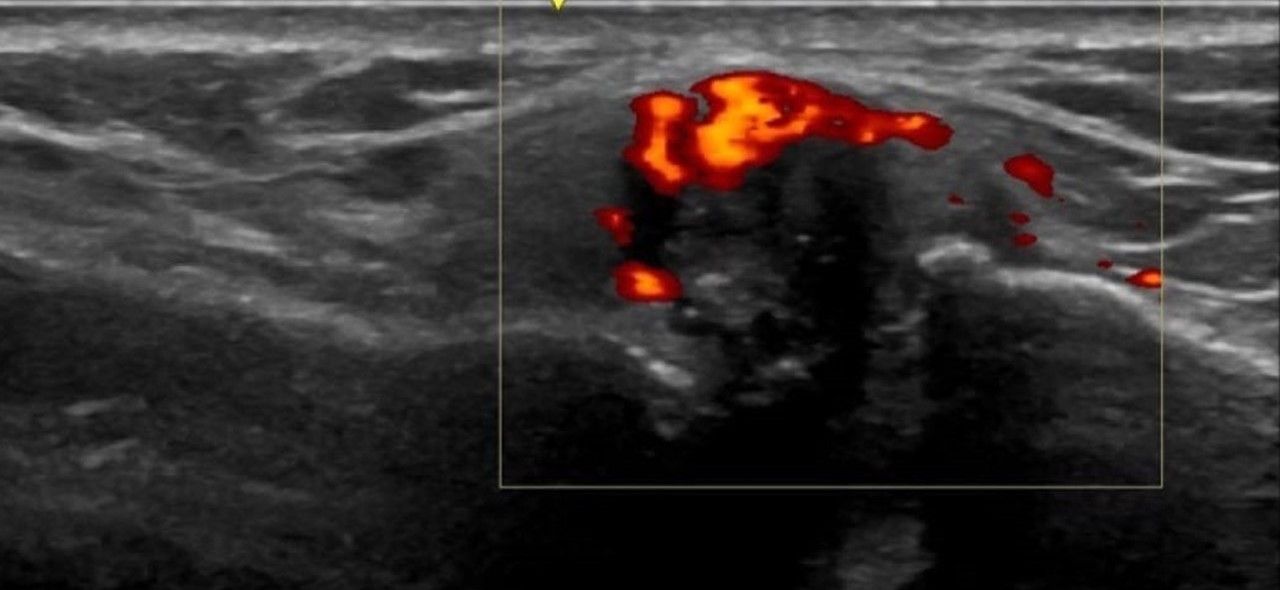 RADIOGRAFIA Y ECOGRAFIA DE HOMBRO OSTEOARTRITIS ACROMIOCLAVICULAR