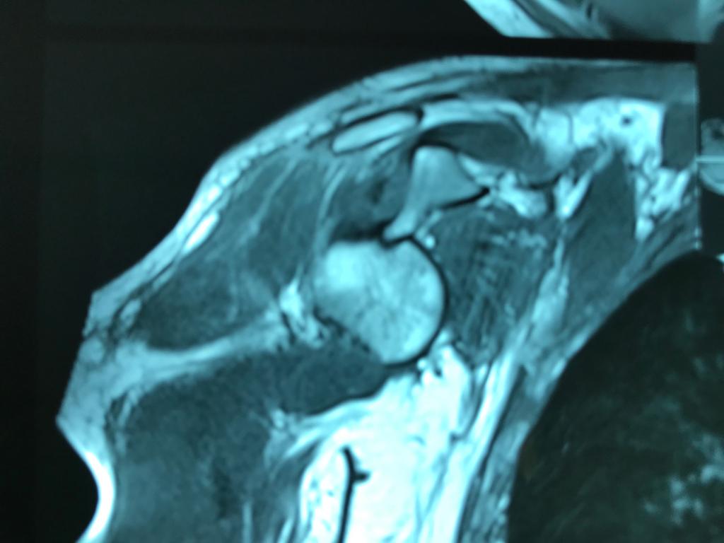 Angioresonancia periférica (miembro superior derecho).