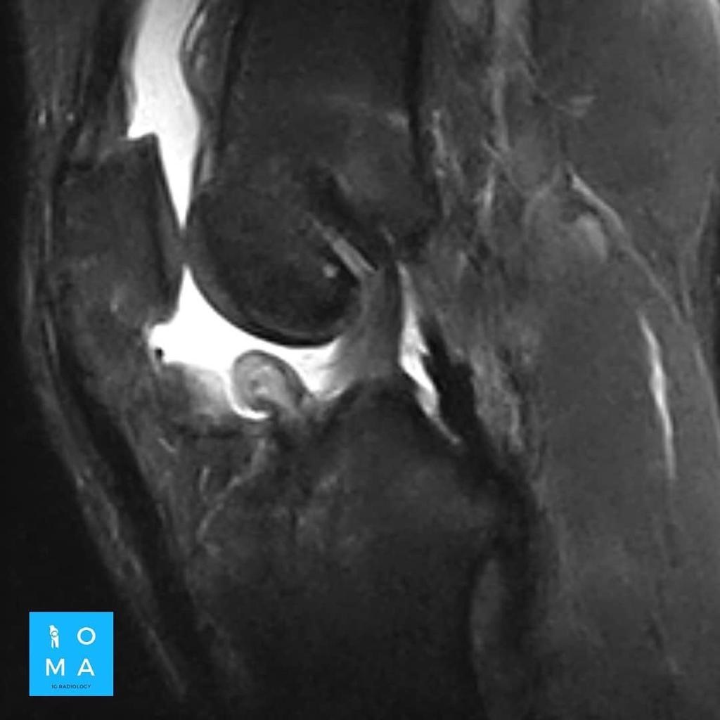 RM en la rodilla operada