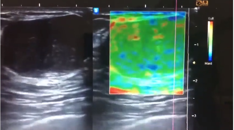 Valores normales de elastografía método ARFI en pacientes sin antecedentes patológicos: