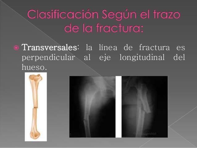 Fracturas por Rx. - Centro de Diagnóstico por Imágenes Linda Vista