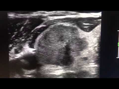 BAAF de tiroides guiada por Ultrasonido.  Carcinoma Papilar de tiroides.