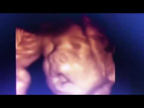 ECOGRAFIA 4D OBSTETRICA