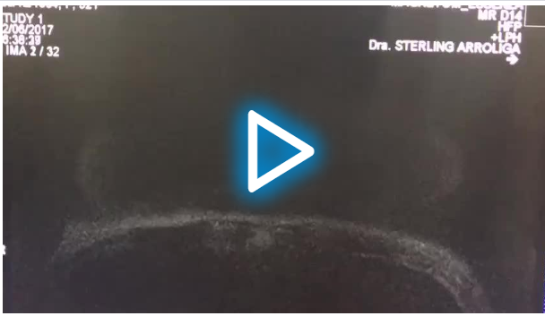 Px con prótesis de mamas.