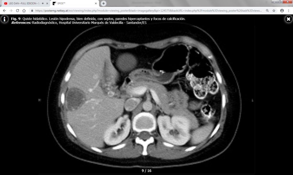 Abscesos Hep Ticos Diagn Stico Radiol Gico Centro De Diagn Stico