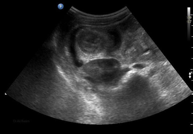 Ultrasonido abdominal en el dolor abdominal agudo.